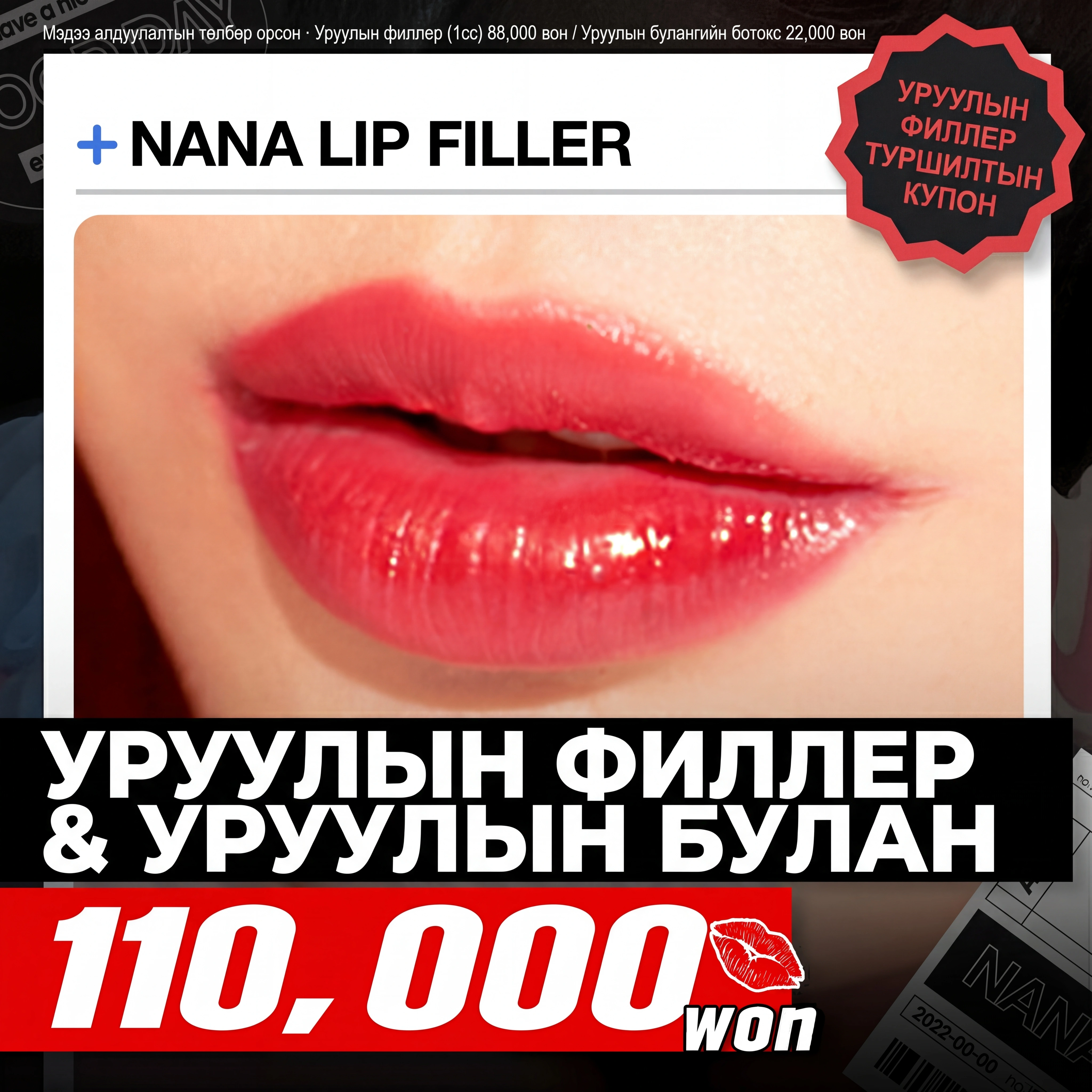 Нана_Уруулын филлер & уруулын булангийн ботокс